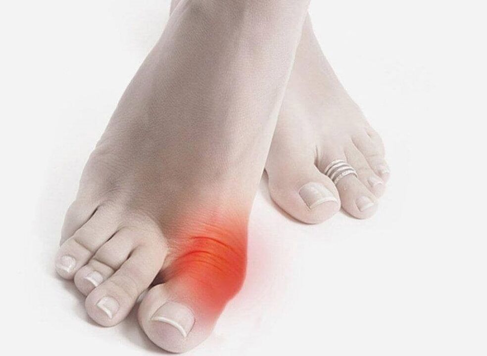 симптоми подагри ніг